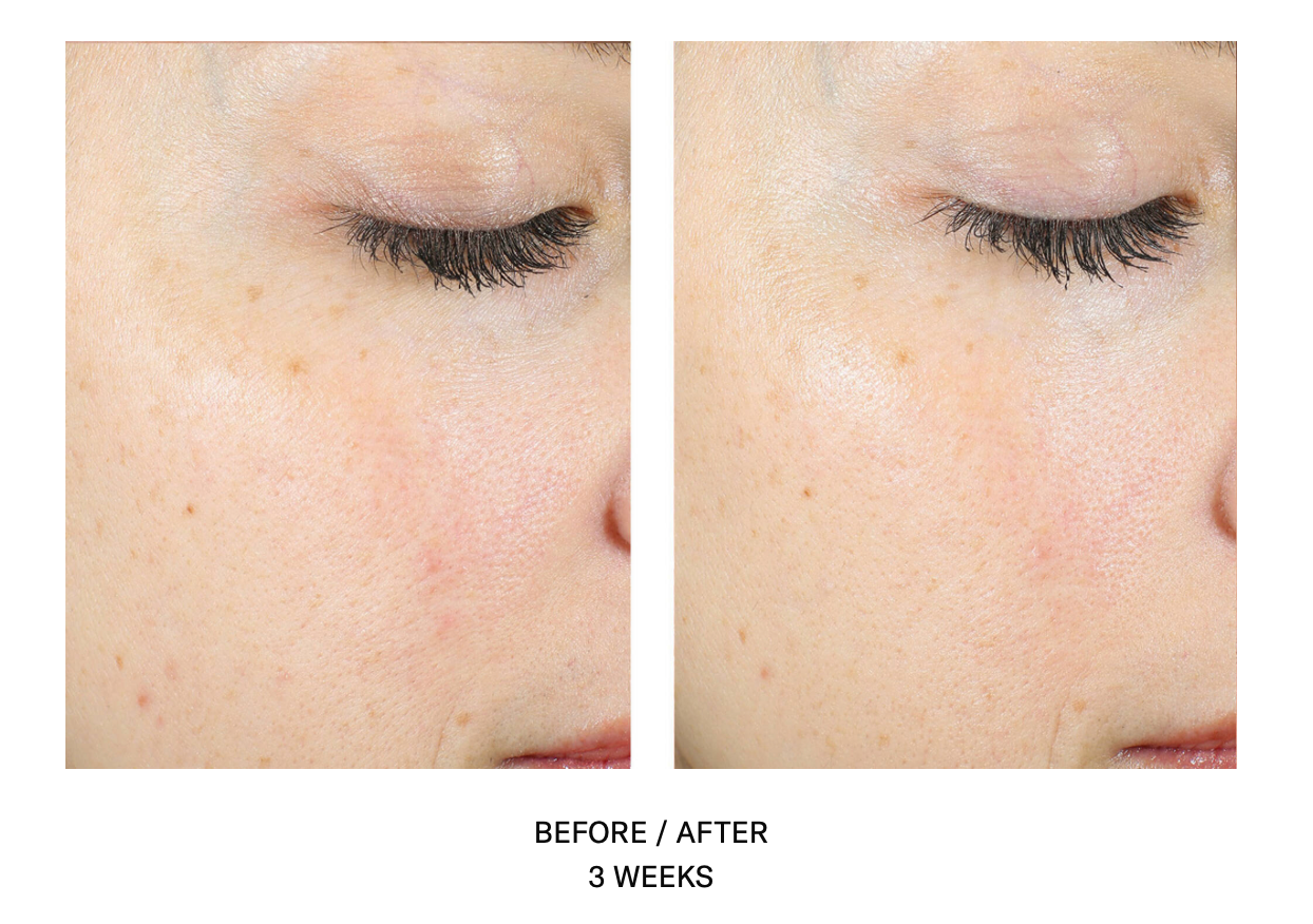 AlphaRet Exfoliating Peel Pads | SkinBetter Science