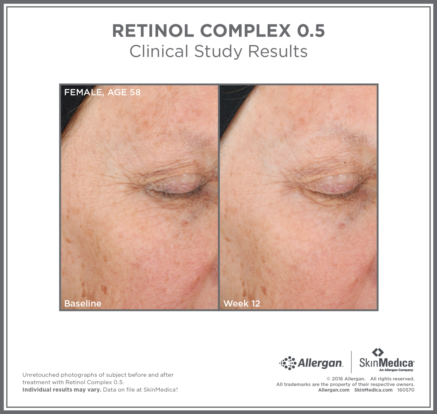 Retinol Complex 0.5 | SkinMedica