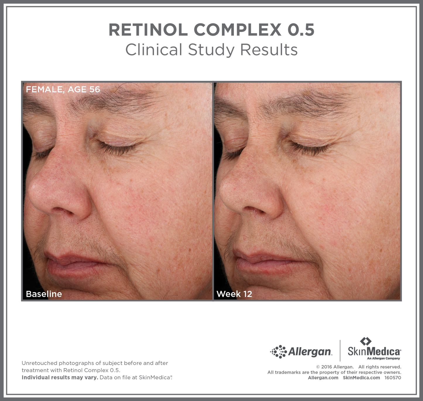 Retinol Complex 0.5 | SkinMedica