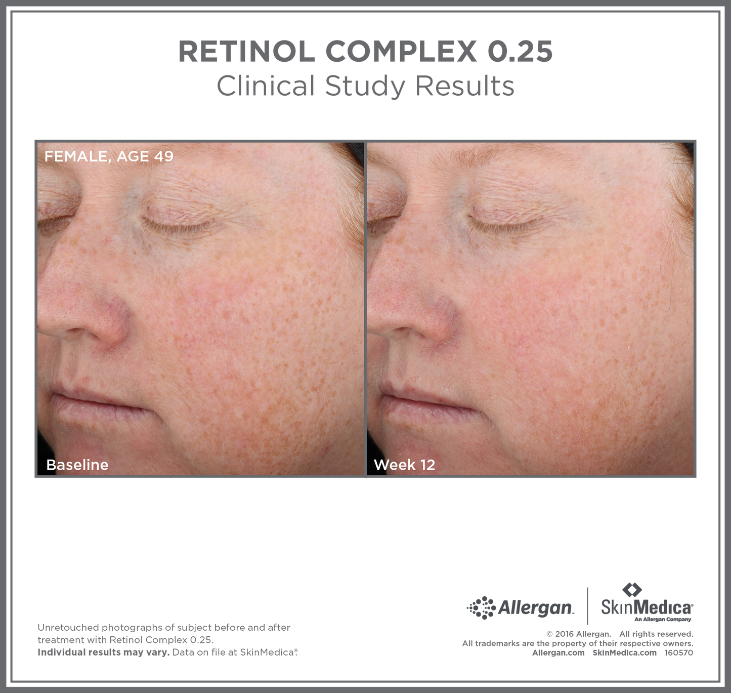 Retinol Complex 0.25 | SkinMedica
