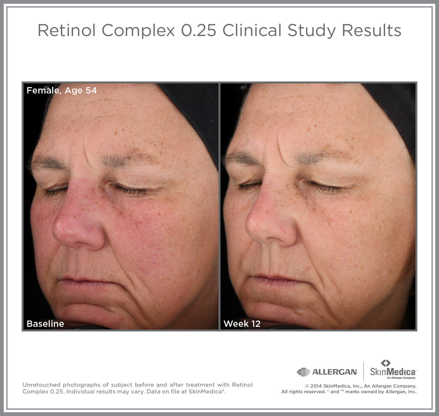 Retinol Complex 0.25 | SkinMedica