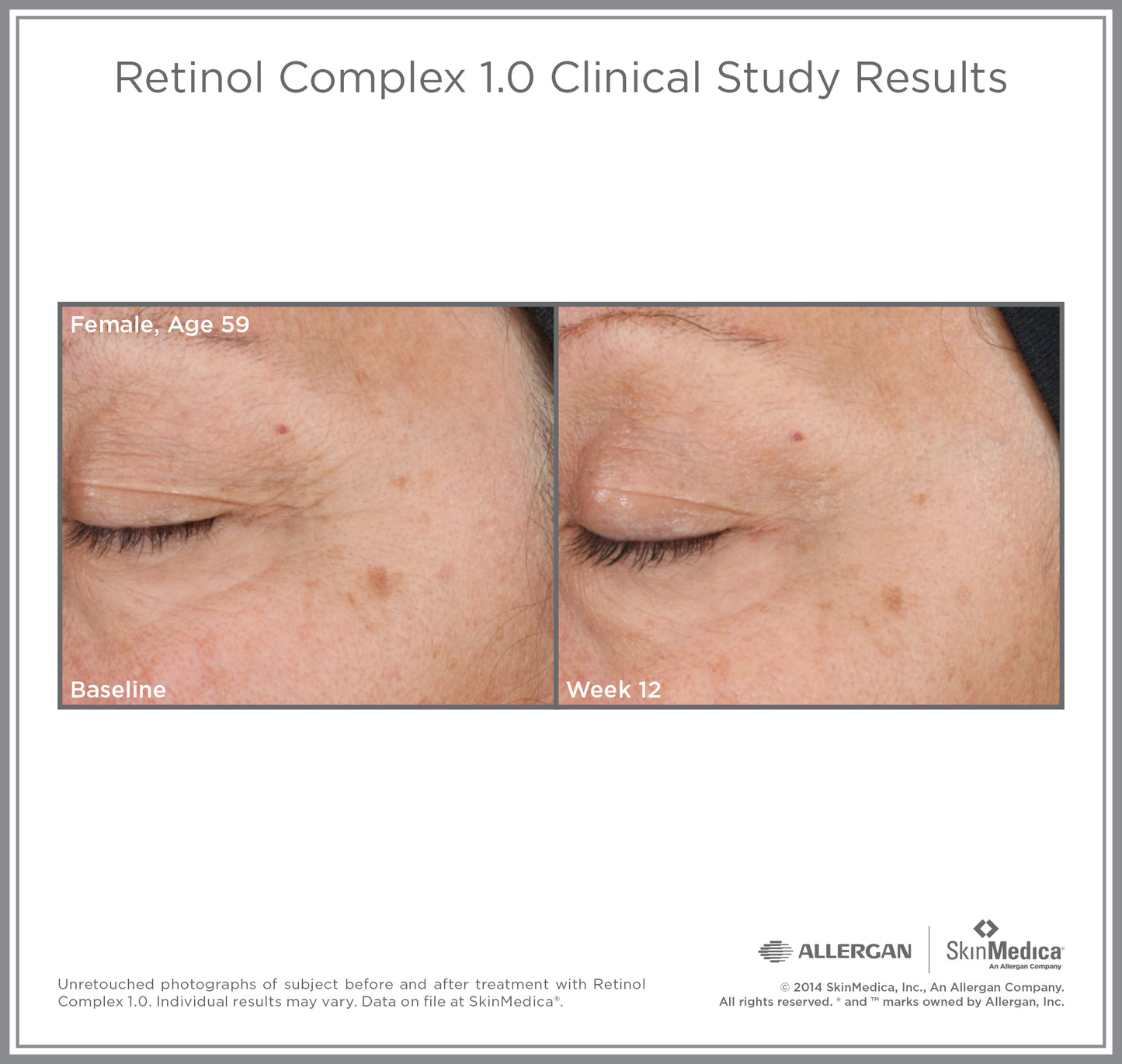 Retinol Complex 1.0 | SkinMedica