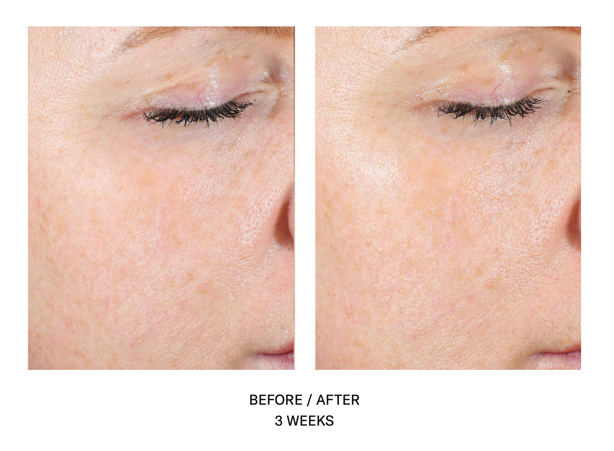 AlphaRet Exfoliating Peel Pads | SkinBetter Science