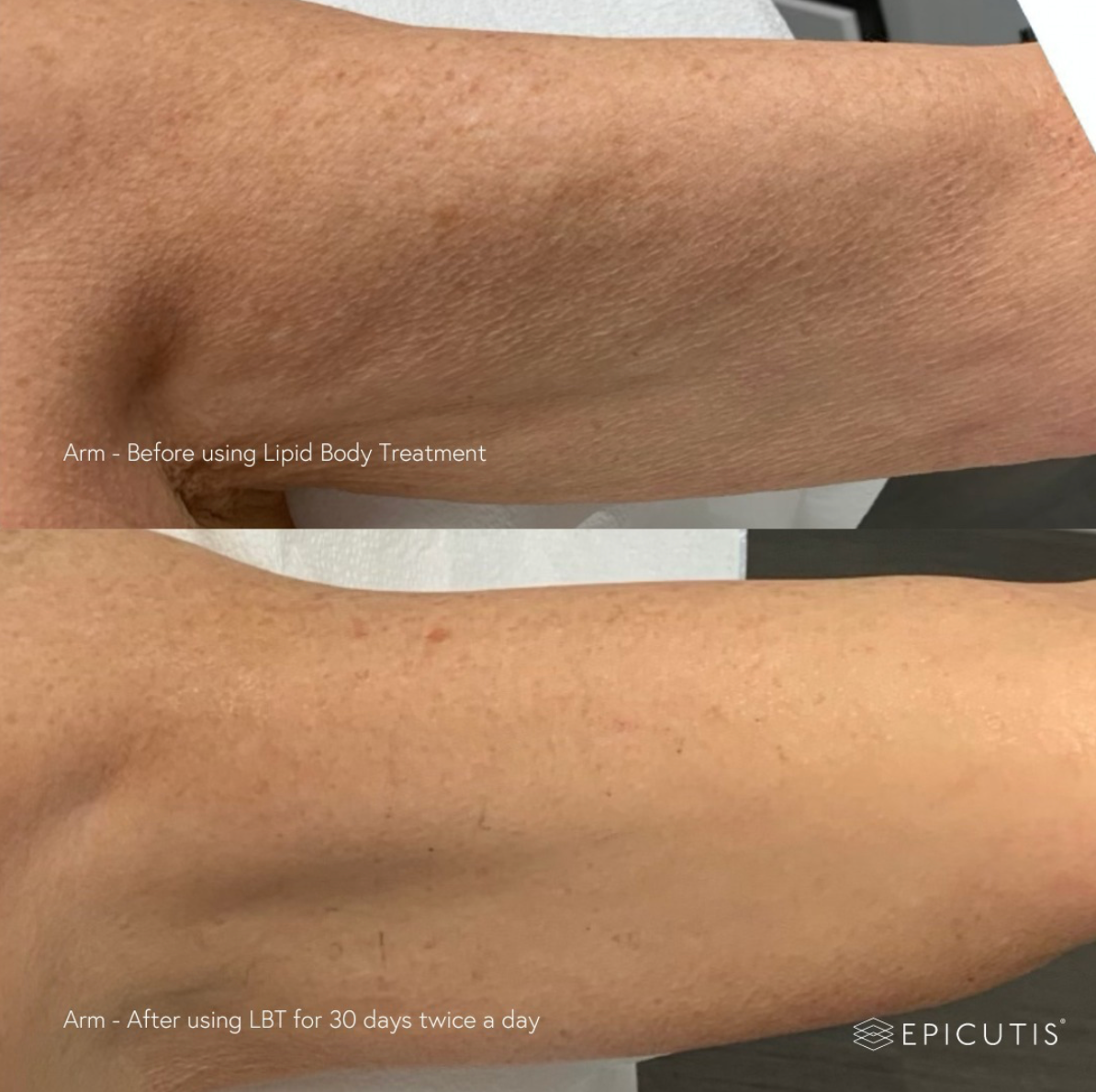 Lipid Body Treatment | Epicutis
