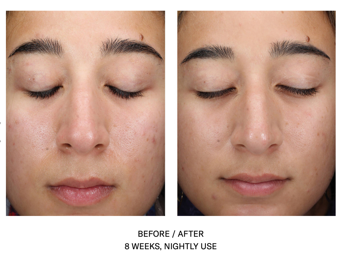 AlphaRet Clearing Serum | SkinBetter Science