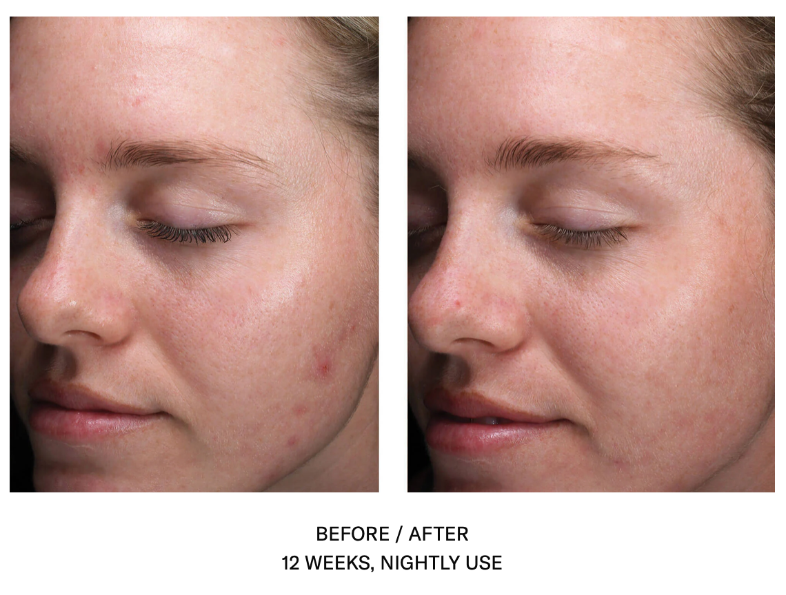 AlphaRet Clearing Serum | SkinBetter Science