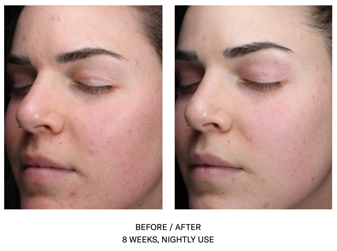 AlphaRet Clearing Serum | SkinBetter Science