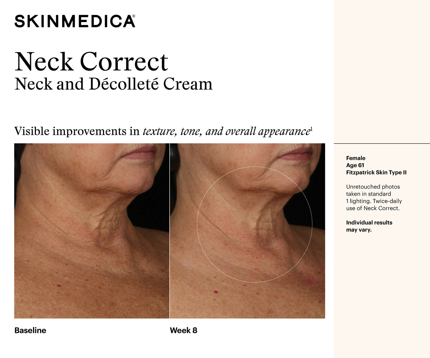 Neck Correct Neck and Décolleté Cream | SkinMedica