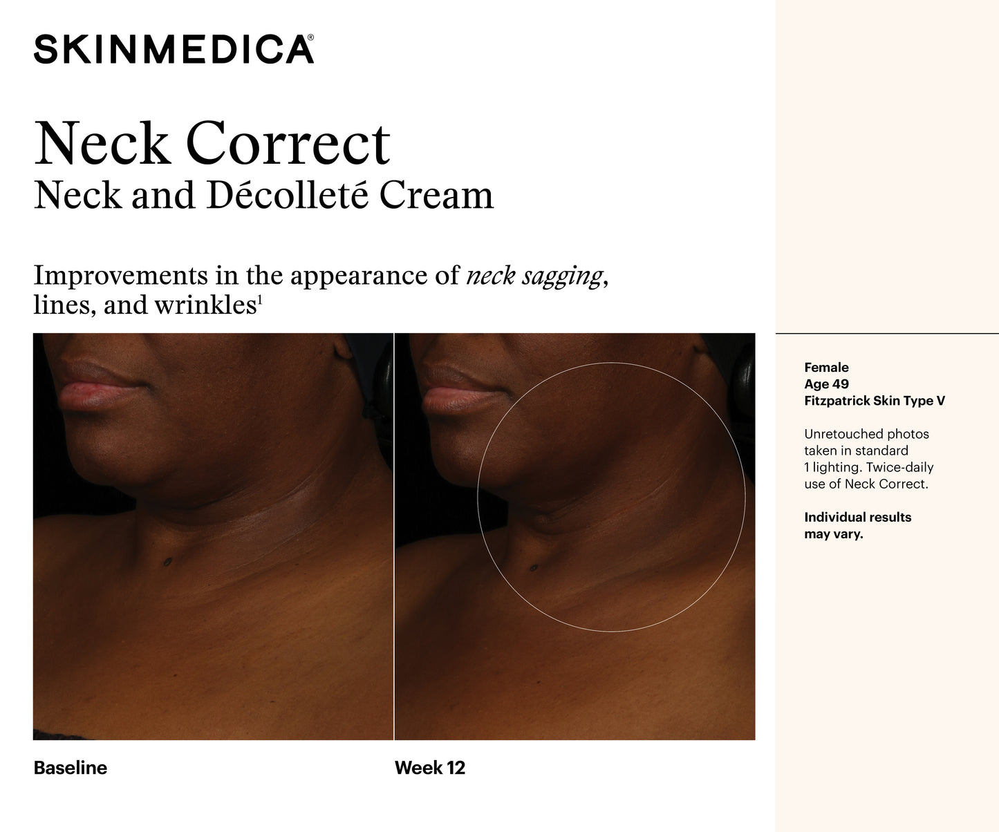 Neck Correct Neck and Décolleté Cream | SkinMedica