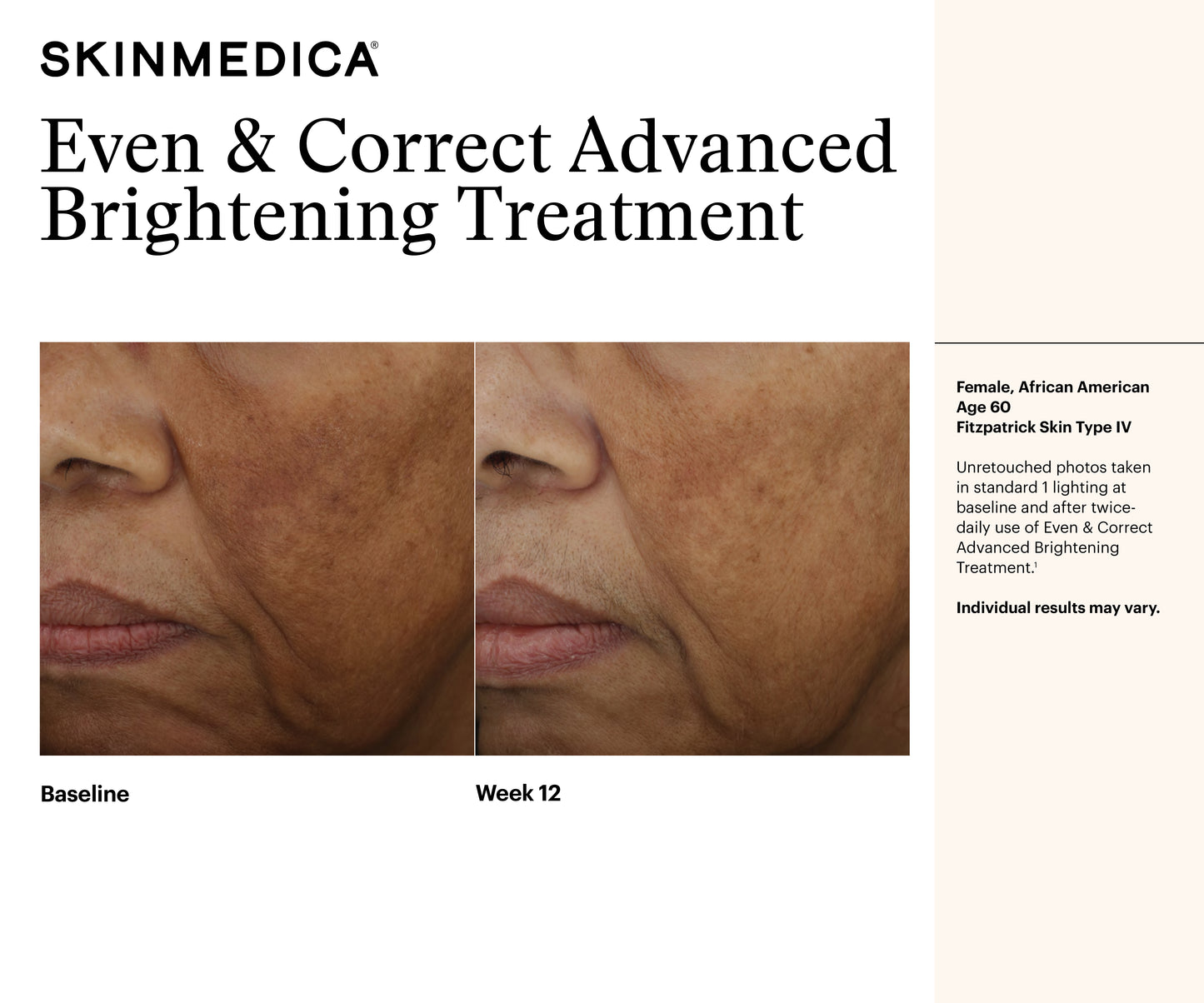 Even & Correct Advanced Brightening Treatment | SkinMedica
