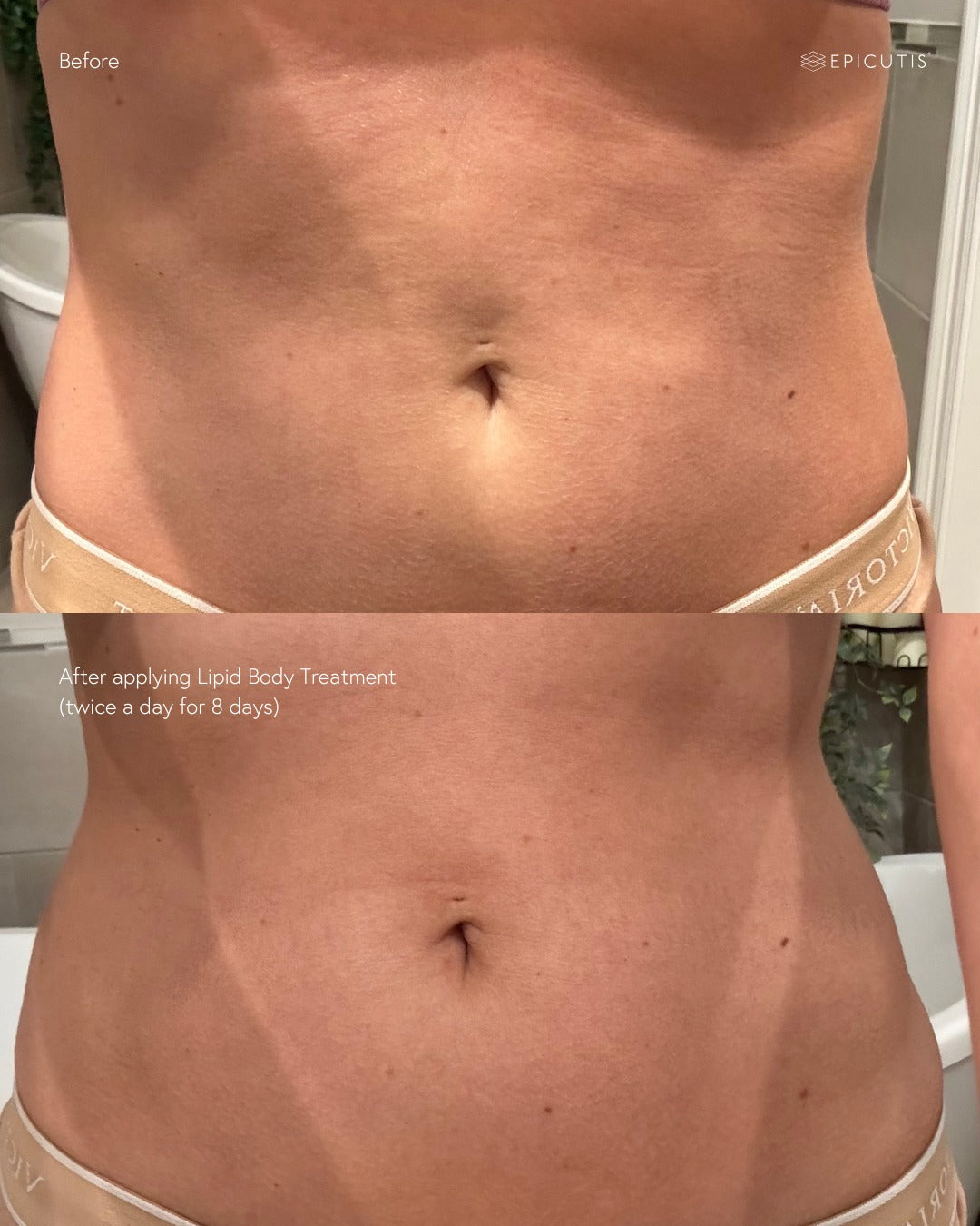 Lipid Body Treatment | Epicutis