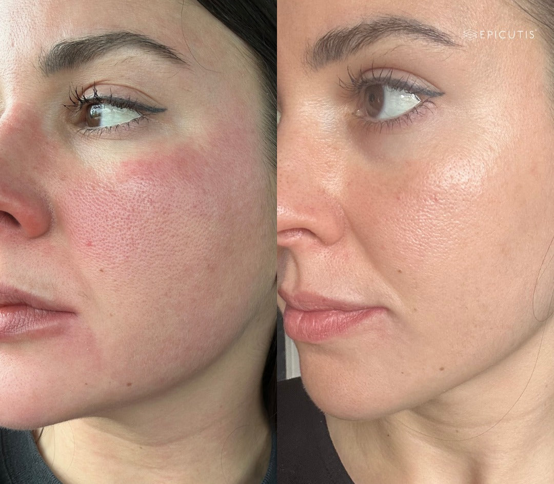 Lipid Serum | Epicutis