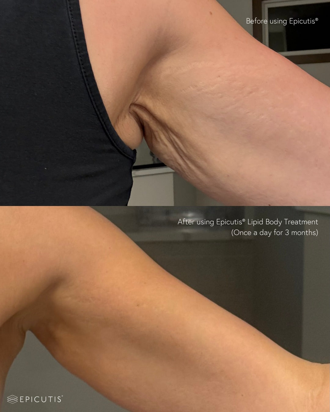 Lipid Body Treatment | Epicutis